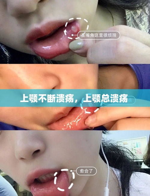 上顎不斷潰瘍，上顎總潰瘍 