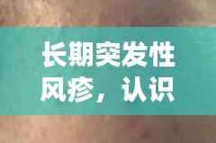 長期突發(fā)性風疹，認識、預防與治療全攻略